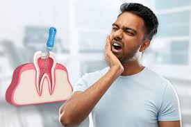 Affordable Root Canal Near Me