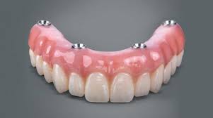 All-on-4 Implants Near Me