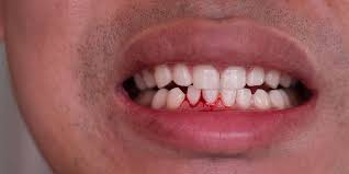 Bleeding Gums Treatment