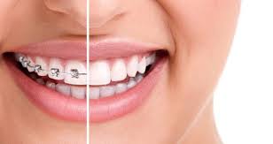 Braces Cost In Hyderabad