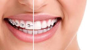 Braces Dentist In Attapur