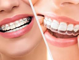 Braces Dentist In Mehdipatnam