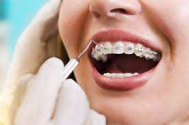 Braces Treatment Near Me