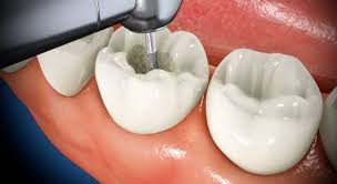 Cavity Filling Near Me