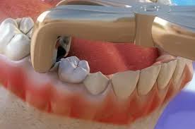 Complicated Tooth Extraction