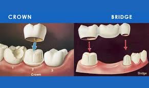 Crown And Bridge Dentist Mehdipatnam