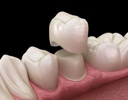 Dental Crowns In Attapur