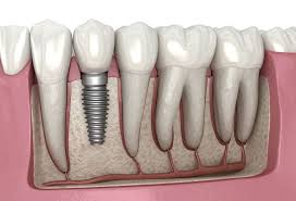Dental Implants Near Me
