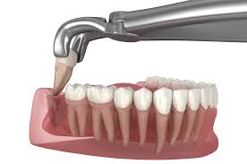 Extraction Dentist Mehdipatnam