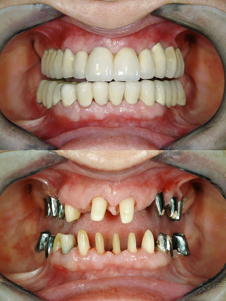 Full Mouth Rehabilitation (FMR)