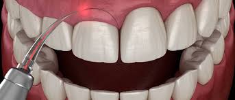 Gum Surgery Near Me