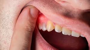 Gums Treatment Near Me
