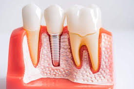 Implant Specialist Mehdipatnam