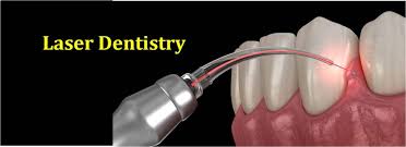 Laser dentistry