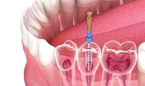 Painless Root Canal Near Me