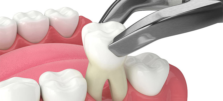 Painless Tooth Removal