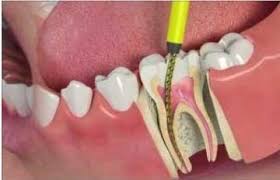 Rct Dentist In Attapur