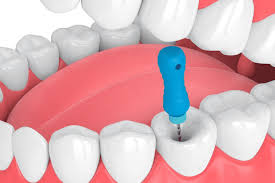 Rct Dentist In Tolichowki