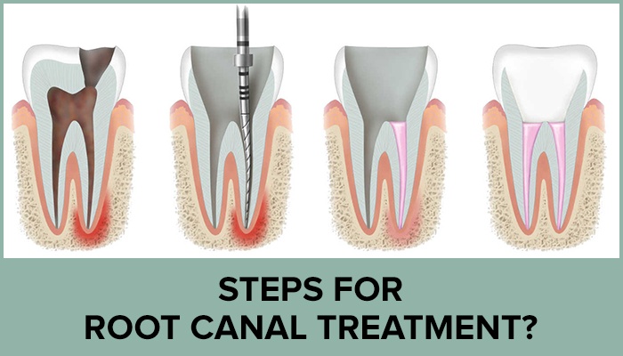 Root Canal Clinic Mehdipatnam