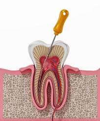 Root Canal Treatment Near Me