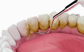 Scaling Dentist Rajendranagar