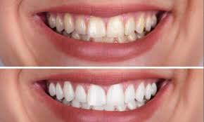 Teeth Whitening Cost