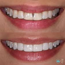 Teeth Whitening In Attapur