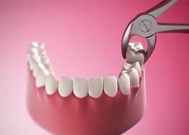 Wisdom Tooth Removal Near Me